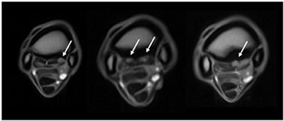 Magnetic Resonance Imaging Findings of the Proximal Metacarpal Region in Warmblood Horses: 36 Lame and 26 Control Limbs (2015–2021)